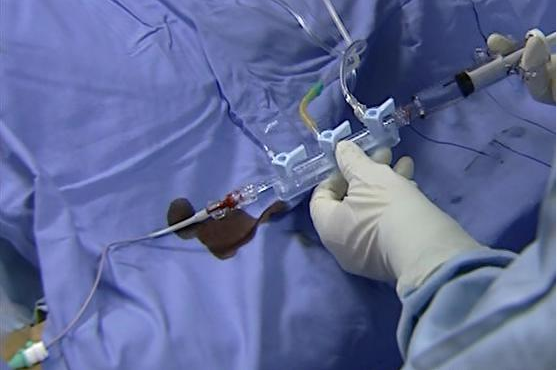 科普:心脏支架手术图解过程